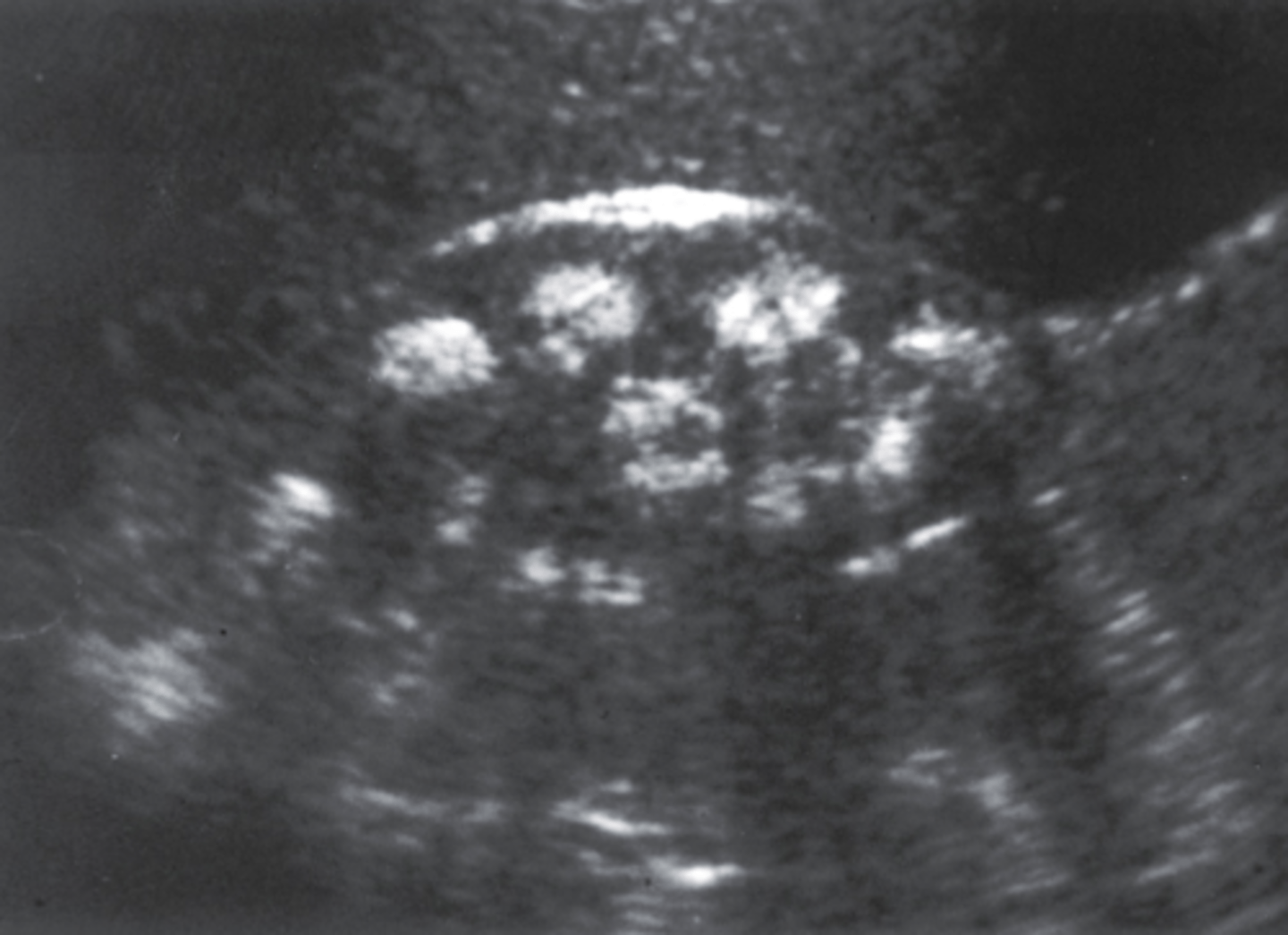 <p>b. Medullary nephrocalcinosis</p>
