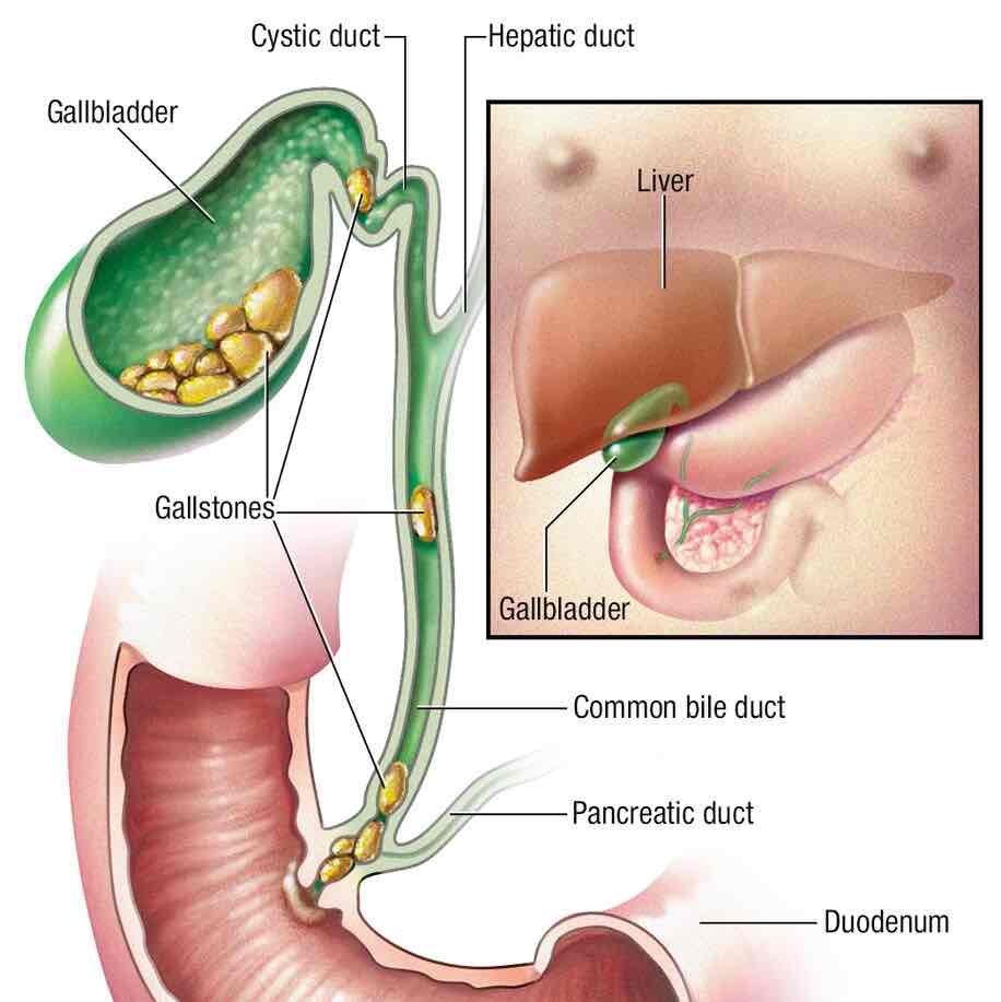 <p>Condition of having gallstones</p>