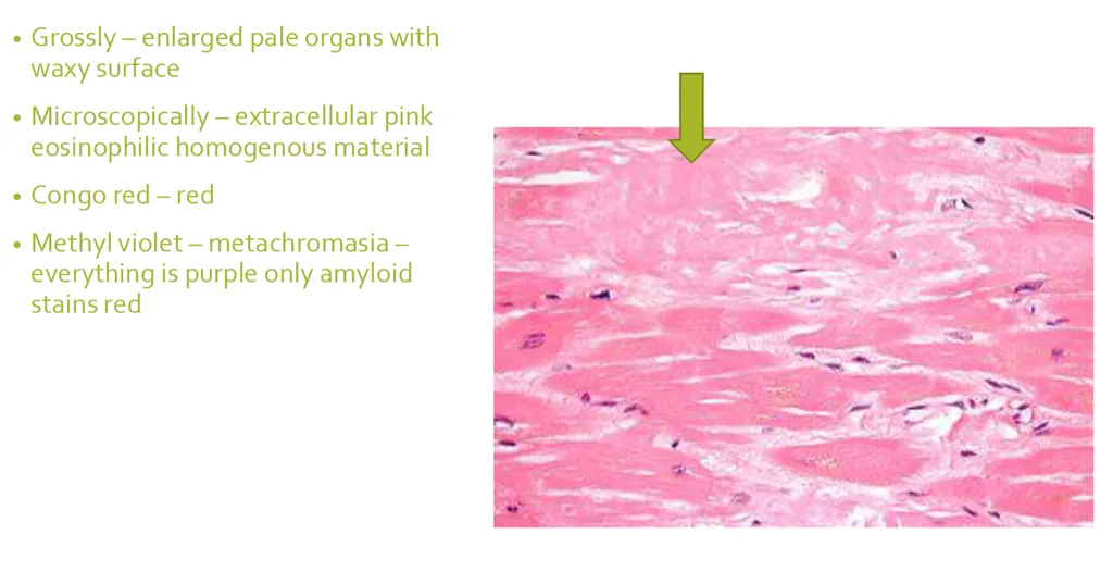 <p><strong><span>Which of the following stain(s) is used to prove amyloidosis?</span></strong> (2)</p><p>a) Perls, </p><p><strong>b) Congo-Red, </strong></p><p>c) Van Gieson, </p><p><strong>d) Methyl violet</strong></p><ul><li><p>Congo red - red/orange = positive</p></li><li><p>Methyl violet - metachromasia, everything purple just amyloid - red</p></li></ul><p></p>