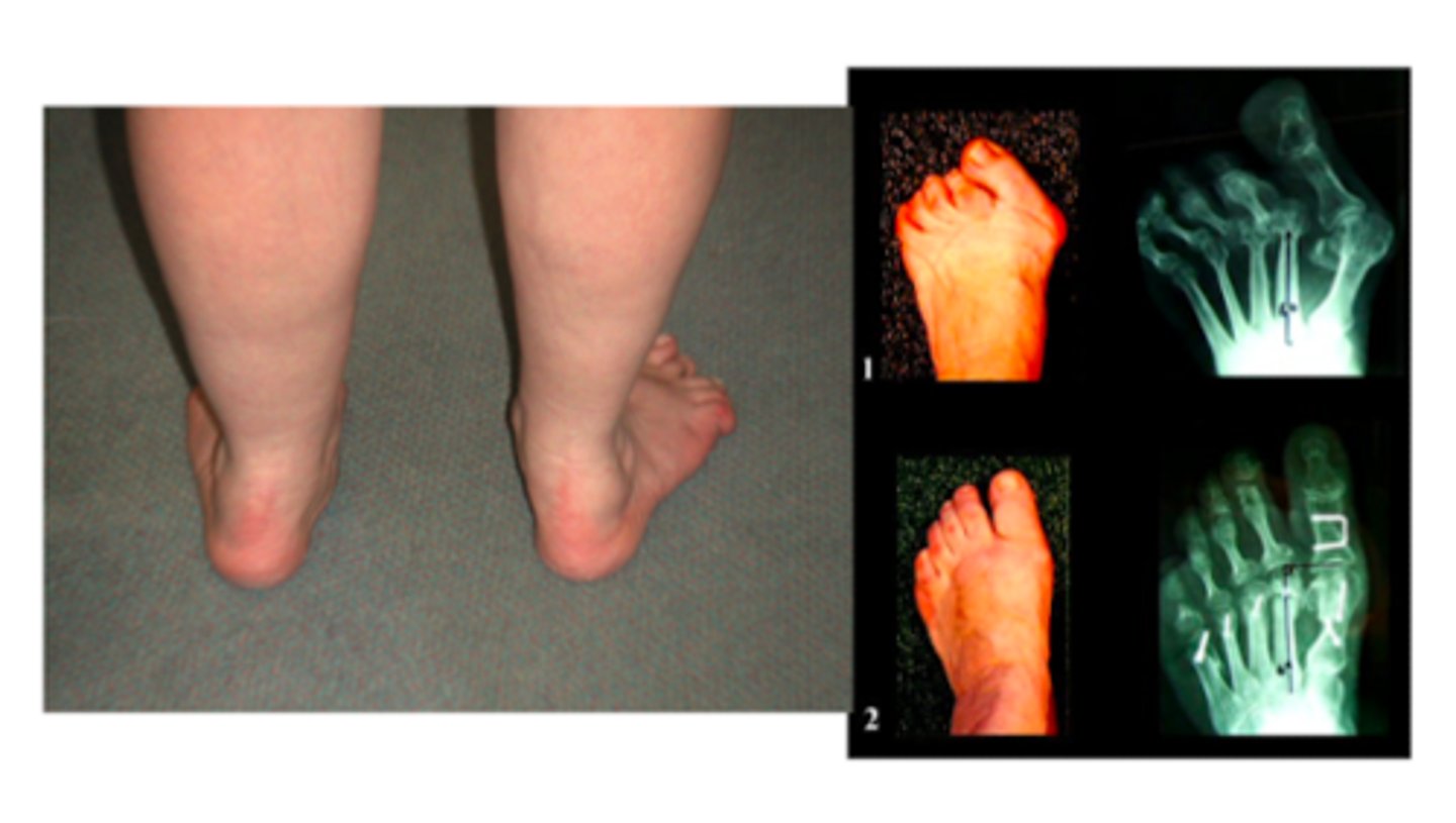 <p>valgus deformity</p>