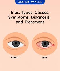 <p>PP: eye infection→diffuse conjunctival injection</p><p>E: systemic infection<br>herpes zoster<br>tuberculosis<br>autoimmune diseases</p><p>CM: moderate/aching/deep pain<br>decreased vision+photophobia<br>no discharge<br>small+irregular pupil<br>clear/slightly clouded cornea+injection confined to corneal limbus</p><p>TX: refer promptly to specialist</p>