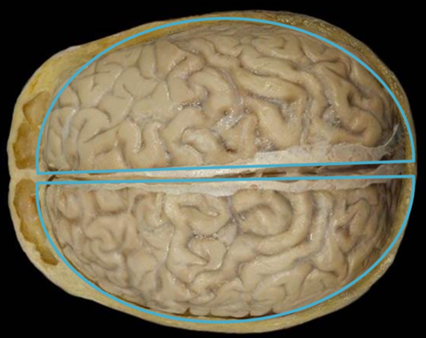 <p>Divided into right and left by the cerebrum.</p>