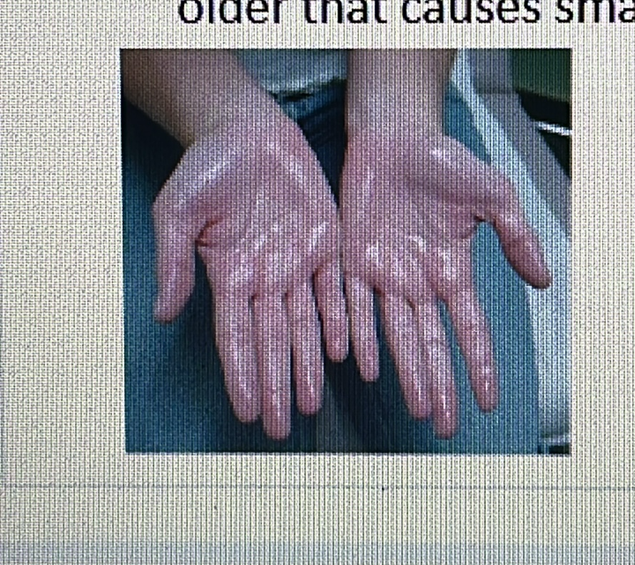 <p>GLAND DISORDER</p><p><span style="font-family: Calibri, sans-serif"><strong>Hyperhidrosis: Excessive sweating.</strong></span></p>