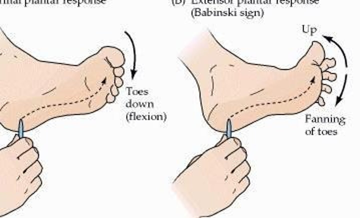 <p>Babinski's sign; abnormal response is flared toes, which may indicate ALS or other damage/disorder of CNS.</p>