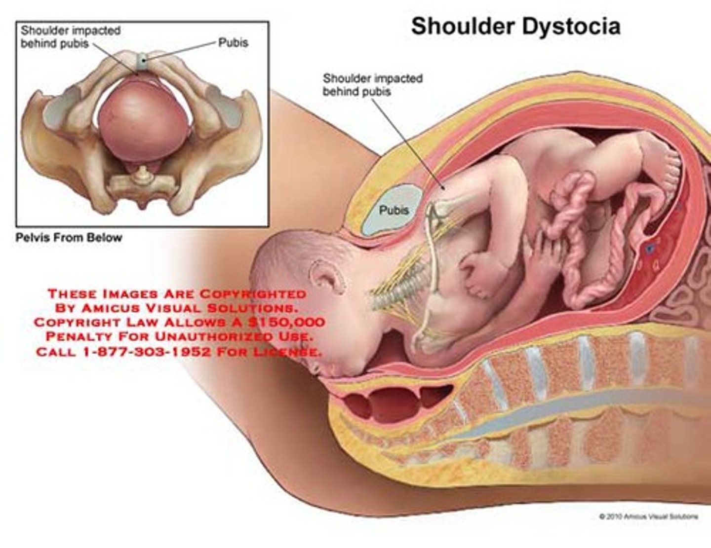 <p>delayed or difficult birth of the fetal shoulders after the head is born</p>