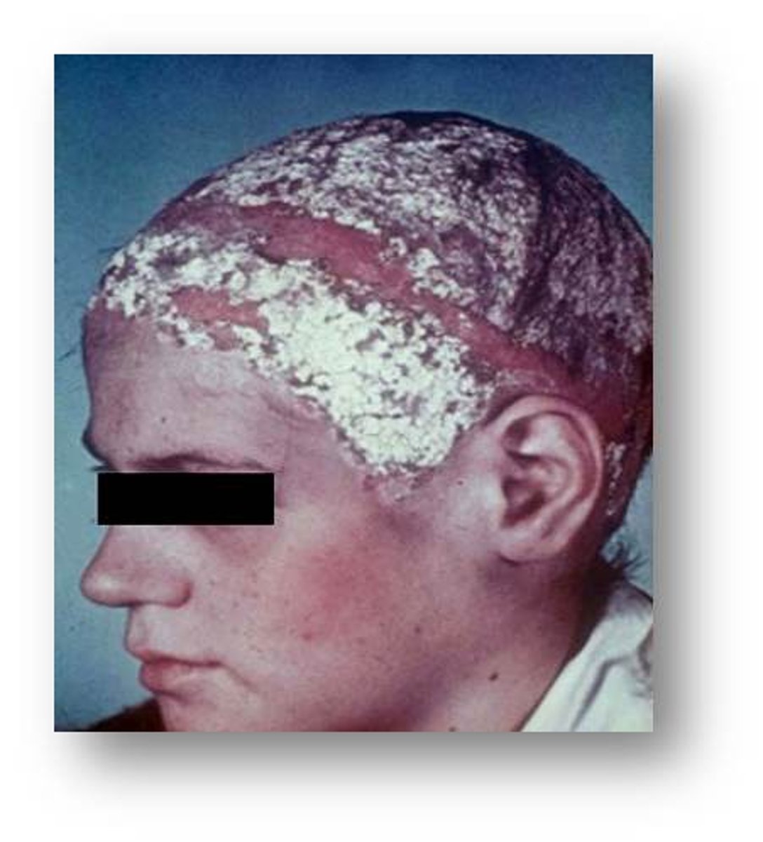 <p>(tinea favus) fungal infection characterized by dry, sulfur-yellow, cup-like crusts on the scalp called scutula.</p>