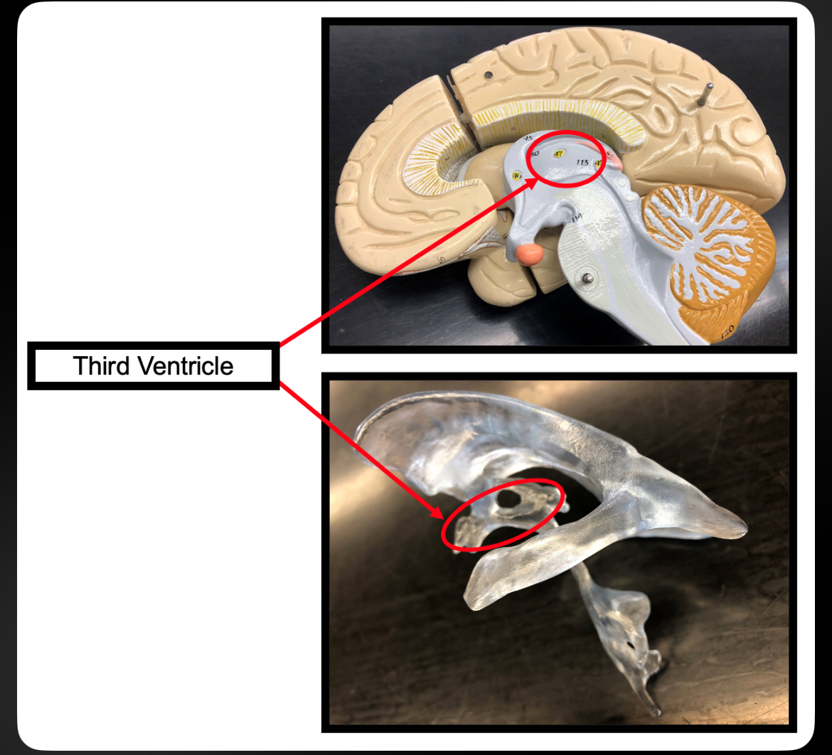 <p>Third Ventricle</p>