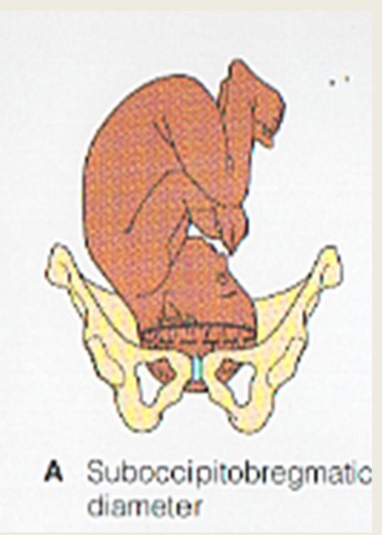 <ul><li><p>occipito- anterior position </p></li><li><p>Well flexed head </p></li><li><p>SOB diameter of 9.5cm</p></li><li><p>Bi- parietal diameter of 9.5cm</p></li></ul><p></p><p></p>