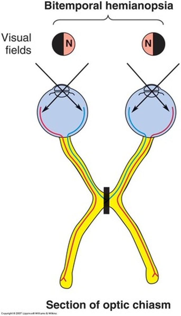 <p>Bitemporal heminopia (tunnel vision)</p>