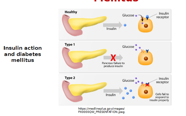 <ul><li><p>Autoimmune destruction of beta cells</p></li><li><p>Absolute insulin deficiency-WHY? because there isn’t any other organ or gland that can produce insulin leads to hyperglycemia</p></li><li><p>require daily insulin injections multiple times a day  </p></li></ul><p></p>