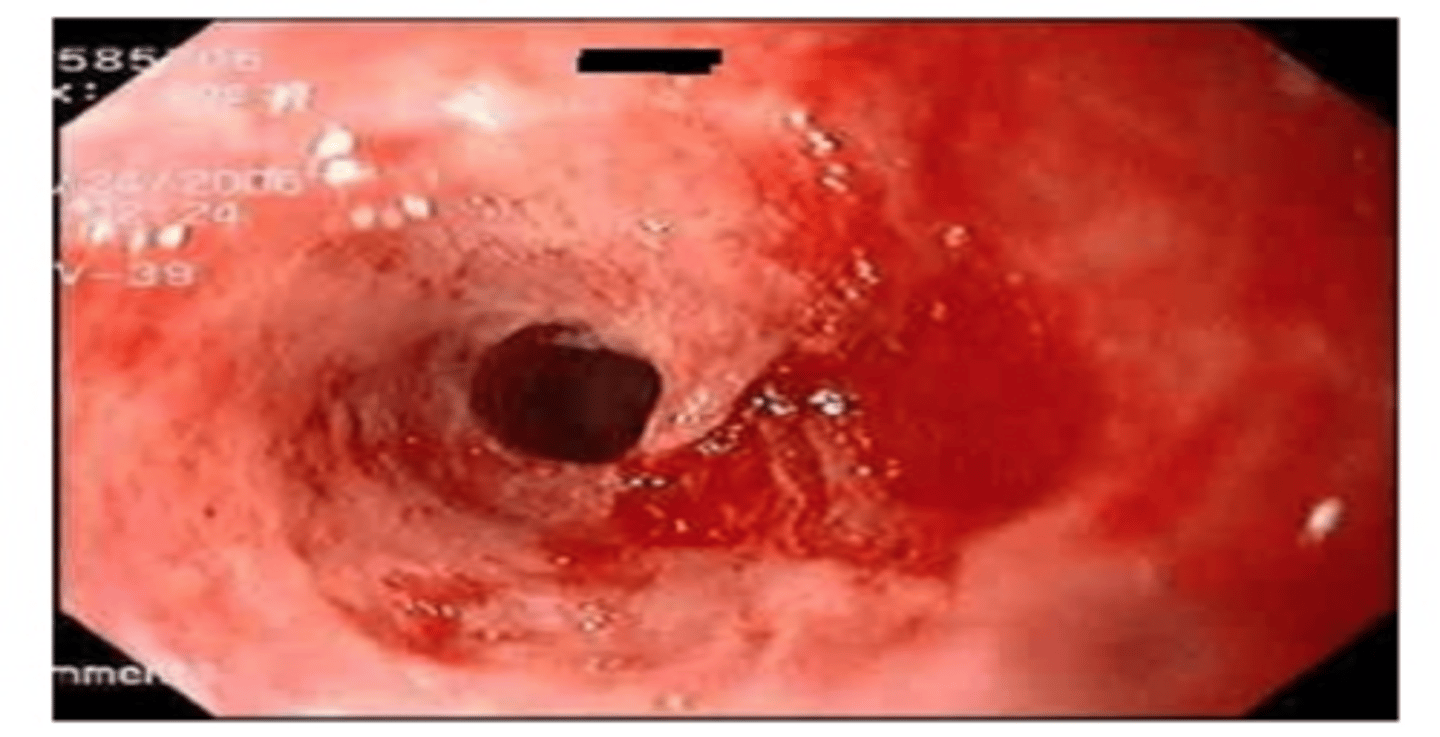 <p>pill-induced esophagitis</p>
