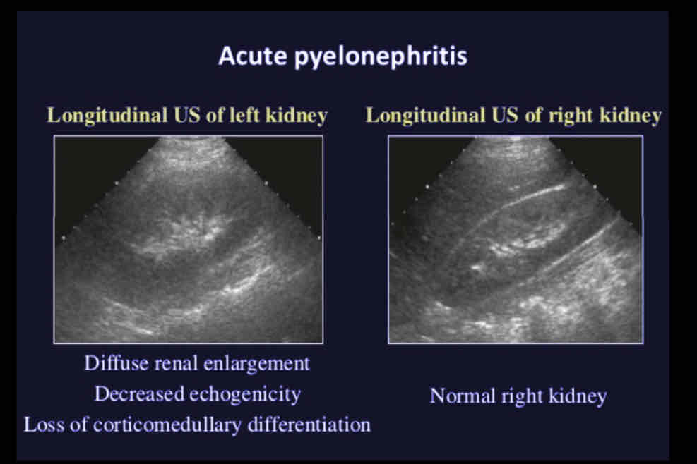 <p>What does the following describe?</p><p><span>• Most renal infections occur via ascending route from bladder. Usually results from bacterial invasion. Imaging studies often not ordered because patient diagnosed by clinical</span><br><span>symptoms</span><br><span>Clinical presentation</span><br><span>– Flank pain</span><br><span>– Fever and chills</span><br><span>Laboratory results</span><br><span>– Elevated WBC</span><br><span>– Pyuria</span><br><span>– Bacteremia</span><br><span>– Microscopic hematuria</span></p>