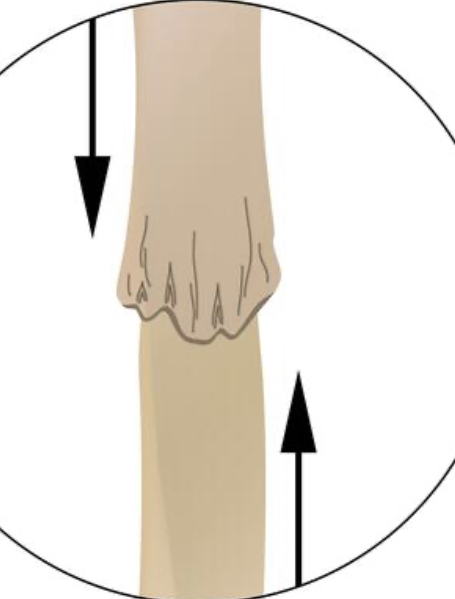 broken bone ends are forced into each other

