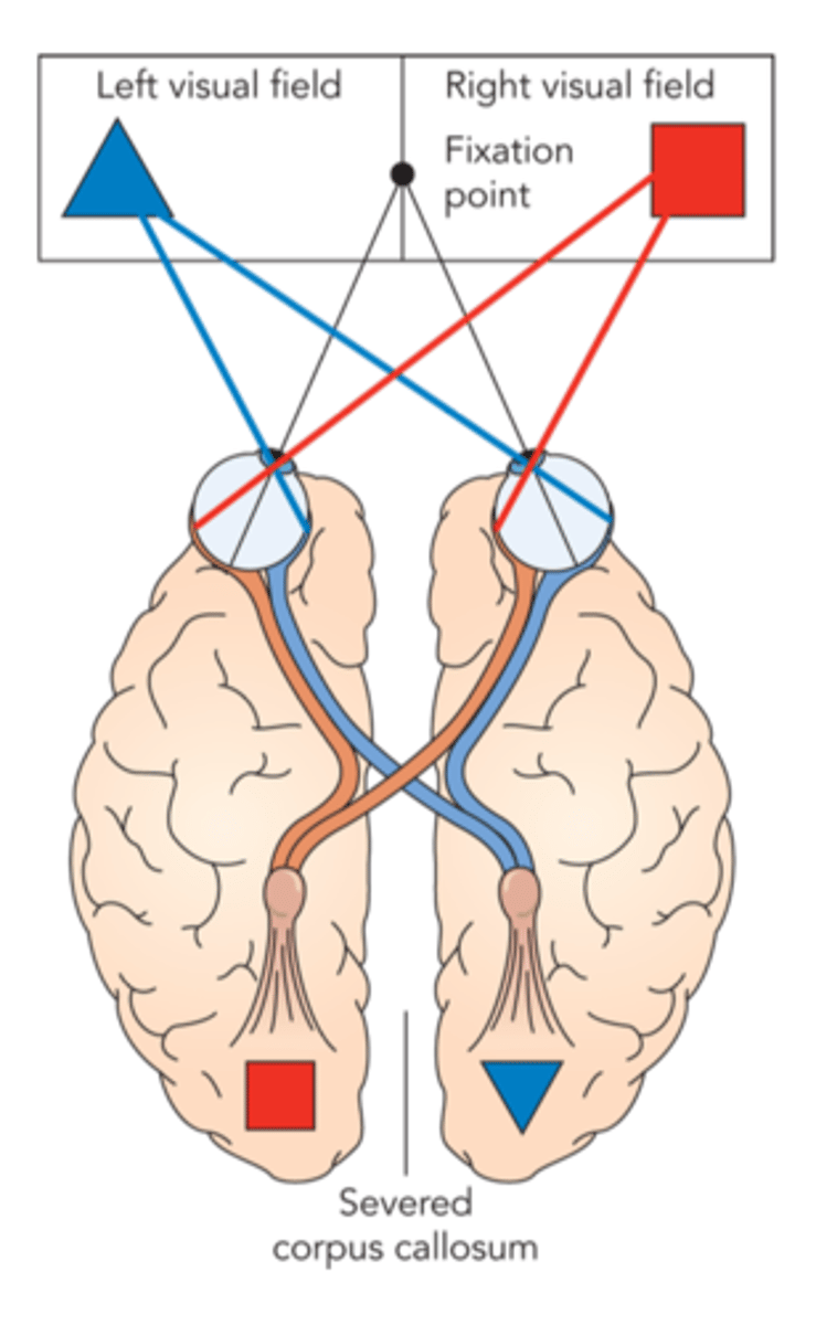 <p>- Parts of brain removed to alleviate symptoms of epileptic seizures: <strong>Callosotomy</strong>: severing corpus collosum, if seizures are lateralized it prevents the seizure from crossing over to the opposite hemisphere </p><p>- Severed corpus collosum these two hem. no longer have main pathway to convey information from one side of the brain to the other, two separate brains in one </p><p>- optic nerve remains unsevered: <strong>contralateral processing:</strong> left visual field processed in right hemisphere, right visual field processed in left hemisphere </p><p></p><p>information processed in one hemisphere then transmitted to the other hemisphere but for...</p><p><strong>Callosotomy patients:</strong> Information locked in one hemisphere and transmittion cannot occur because of severed corpus collosum</p><p></p><p><strong>Procedure</strong>: Image is flashed to the left of fixation point, asked what they saw. If the information is being processed in the right hemisphere + can no longer communicate, they can't verbalize what they've seen... Left hand being controlled my right hemisphere asked to reach down and grab the object they are able to correctly reach the object. </p>