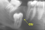 <p>What is the prevalence of dentigerous cyst?</p>