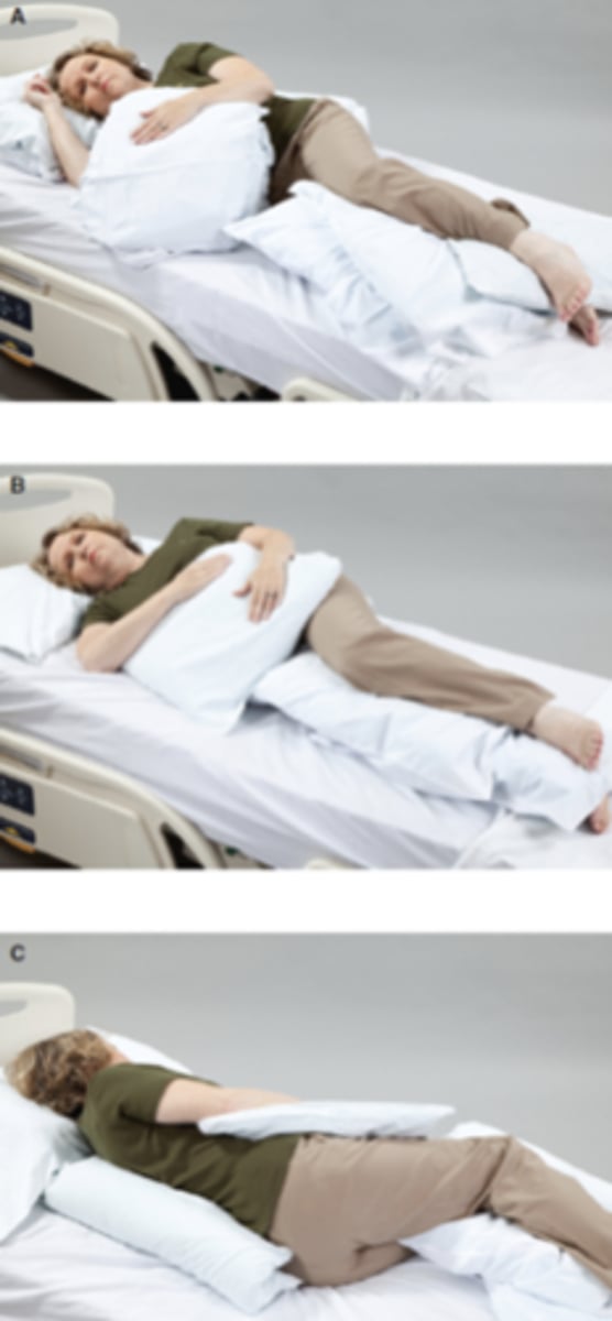 <p>(A) The left arm is supported to prevent the hand from falling below the level of the heart and to minimize stress on the left shoulder. The knees and ankles are cushioned to guard against pressure injuries. The right shoulder is positioned slightly forward to prevent direct pressure through the shoulder and arm, reducing the risk of nerve compression and impaired circulation.</p><p>(B) Here the upper body is rotated slightly posteriorly, and the nonhemiplegic arm rests on the pillow as well.</p><p>(C) To maintain sidelying or partial sidelying, a pillow is folded lengthwise and tucked, open edges inward, under the patient's trunk.</p>
