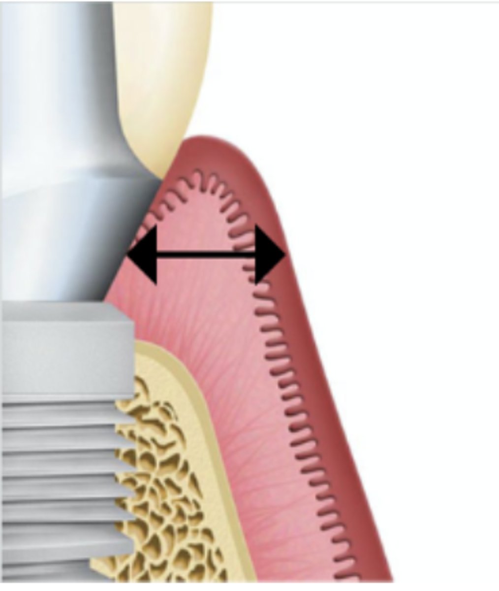 <p>What is the minimum thickness of peri-implant soft tissue in the esthetic zone to prevent Ti-base abutment influence on soft tissue color? (Select one answer)</p><p>1 mm</p><p>2.5 mm</p><p>2 mm</p><p>1.5 mm</p>
