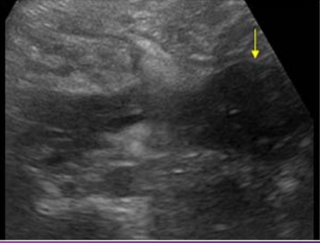 <p>Sonographically, if ____ _____ are present in a pancreatic ______, an ______ region with a ______ posterior is imaged</p>
