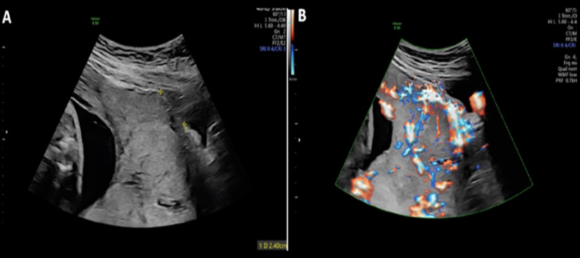 <p>which is described as <strong>invasion</strong> of placental c<strong>horionic villus </strong>through<strong> myometrium + uterine wall</strong></p><p>a) placenta increta</p><p>b) adenomyosis</p><p>c) placenta accreta</p><p>d) placenta percreta</p>
