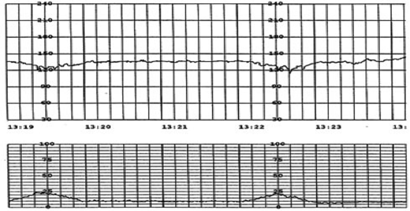 <p>fetal bradycardia (&lt;110/min)</p>