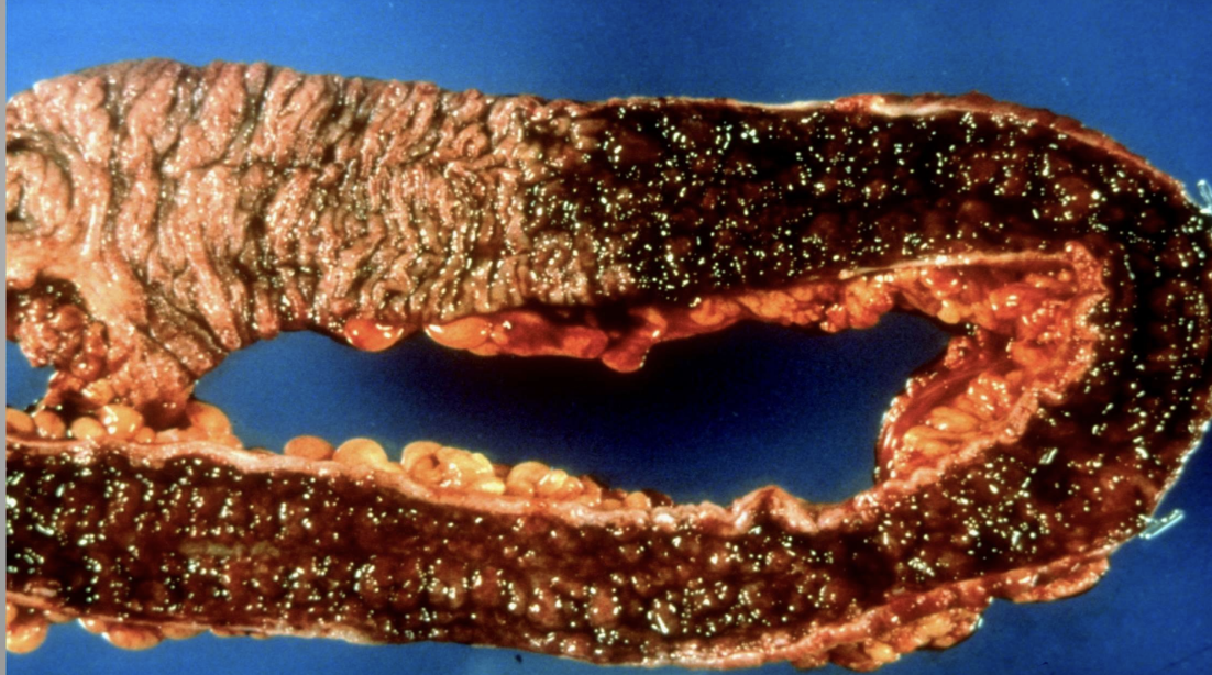 <p>Chronic Ulcerative Colitis</p>