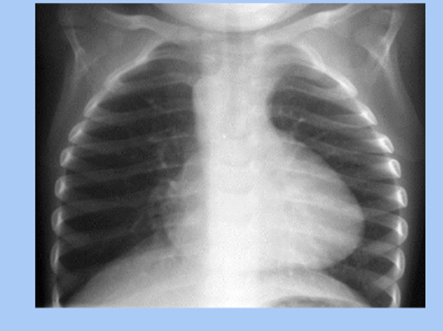 <p>-echocardiogram </p><p>-CXR: boot shaped heart </p>