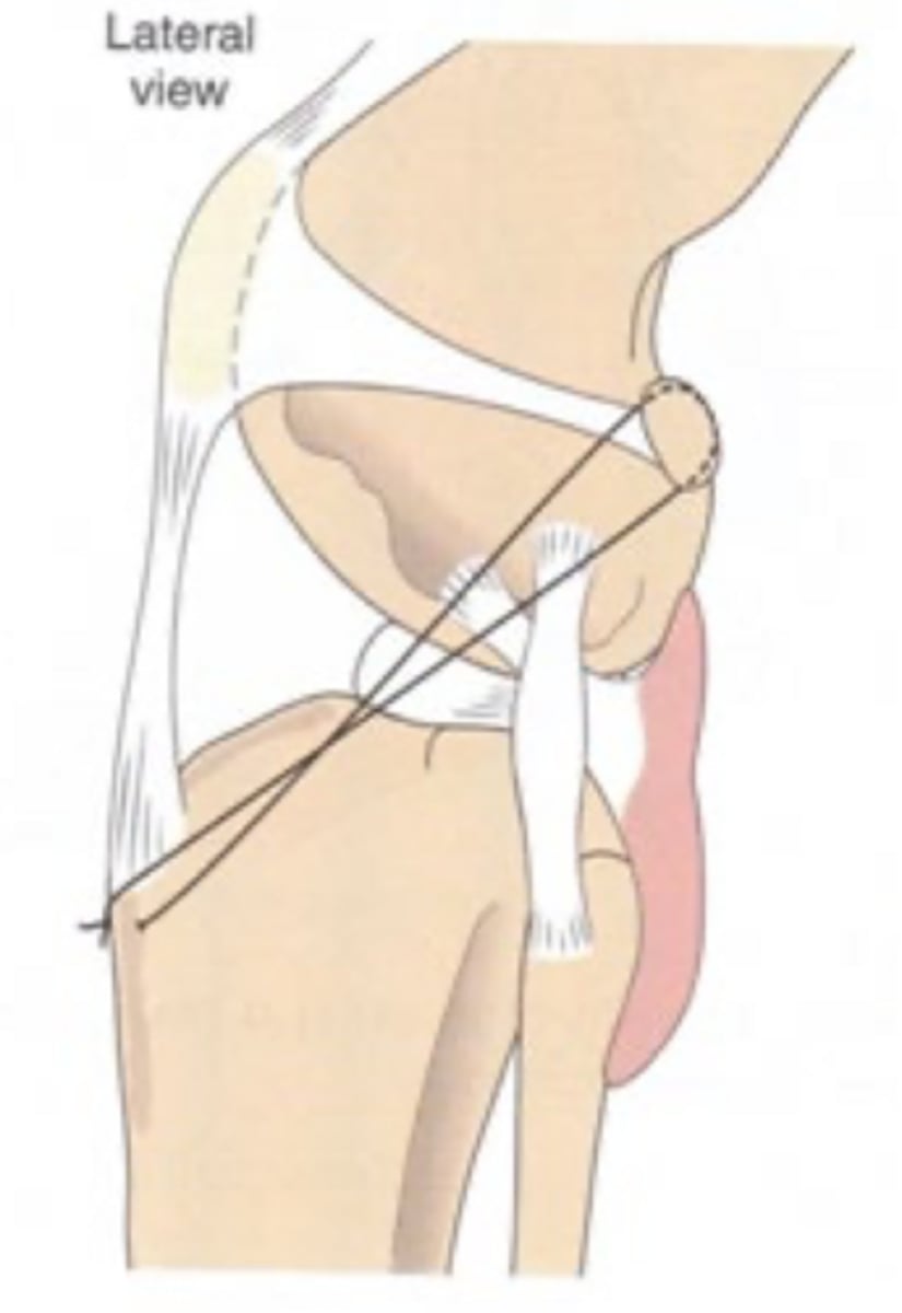 <p>why is the surgical consideration of extra-articular vs. intra-articular CCLD important...</p>