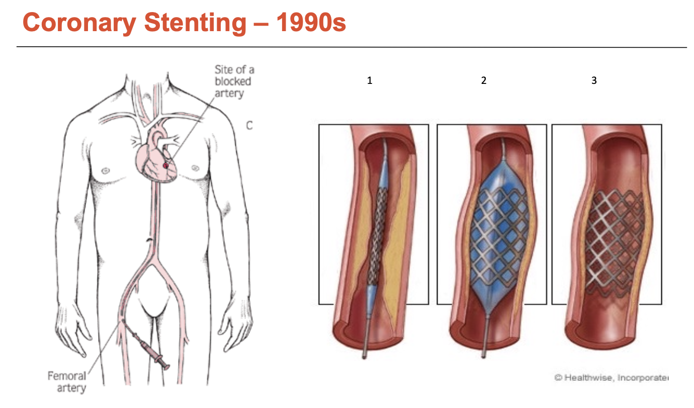 <p>Like balloon angioplasty but using <span>a small, expandable mesh tube to keep artery open</span></p><ul><li><p>stents can only be made of a few handful of metals</p></li></ul><p></p>