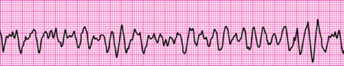 <p>Ventricular fibrillation</p>