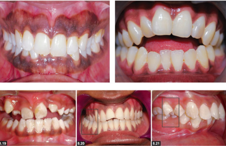 <p>Deep bite</p><p>Open bite</p><p>Anterior open bite</p><p>Posterior- uni or bilateral open bite </p>