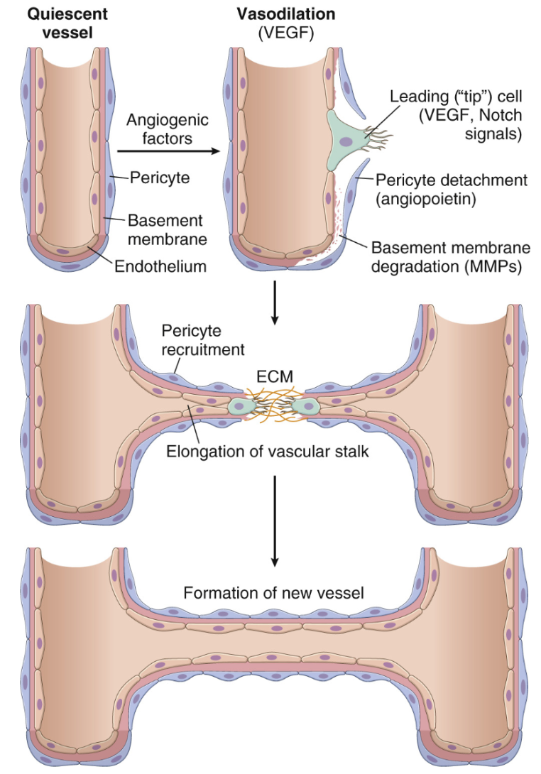 <p>Angiogenes induceras av hypoxi, shear stress och inflammation:</p><ol><li><p>Vasodilatation av <strong>VEGF</strong>.</p></li><li><p>Pericyterna separeras från basalmembranet genom att <strong>MMP2</strong> bryter ner ECM och <strong>angiopoetin</strong> destabiliserar adhesion mellan pericyt och endotel.</p></li><li><p>Endotelceller migrerar mot toppen av migrerande celler, sk “tip cells” med VEGF och <strong>notch signaler.</strong></p></li><li><p>Proliferering (av endotelceller) och rekrytering av <strong>pericyter</strong> till små kärl eller <strong>SMC</strong> till större kärl.</p></li><li><p><strong>Supression</strong> av pro-angiogena faktorer.</p></li></ol>