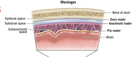 <p>3 types depending on WHERE blood accumulates: </p><p>1. Subarachnoid hemorrhage-bleeding between arachnoid and pia. </p><p>2. Subdural hemorrhage-bleeding beneath dura. </p><p>3. Epidural hemorrhage-bleeding between dura and skull. </p><p>● TBI usual cause of subdural and epidural hemorrhages </p><p>● After bleeding stops, left with a hematoma (subarachnoid, subdural, or epidural)--accumulation of clotted or partially clotted blood in the space created by the hemorrhage.</p>