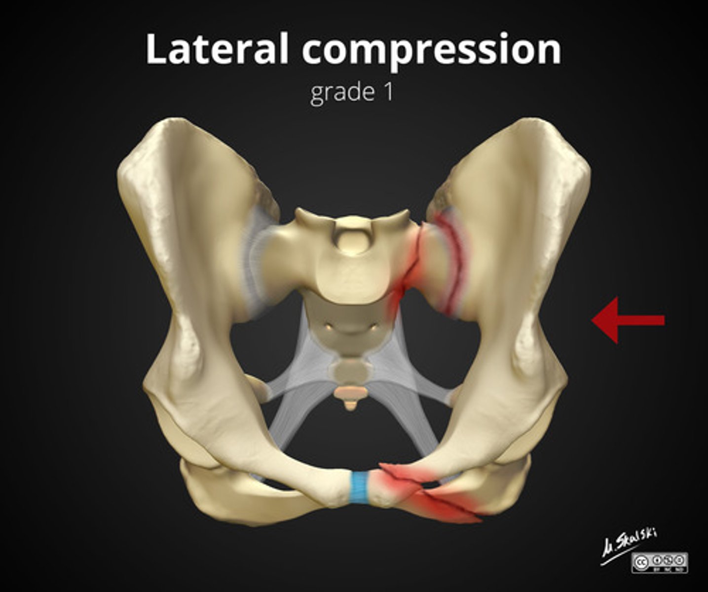 <p>Most common type of pelvic ring fracture?<br>side impact<br>may cause displaced fractures of pubis bone causing damage to organs</p>