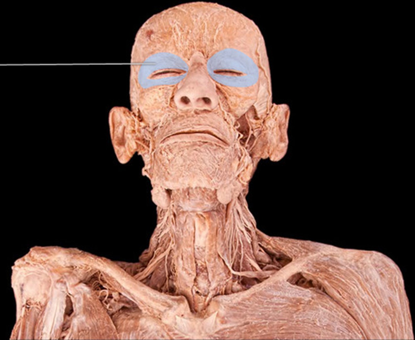 <p>Orbicularis Oculi function</p>