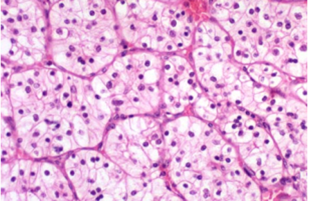 <p><span>On your pathology rotation you are asked to evaluate the following slide and help make a cancer diagnosis for a patient. The pathologist you’re working with informs you it is malignant, arises in the proximal tubule, and is associated with the loss of the short arm of chromosome 3. </span></p><p><span>Based on this information you make the diagnosis of: </span></p>