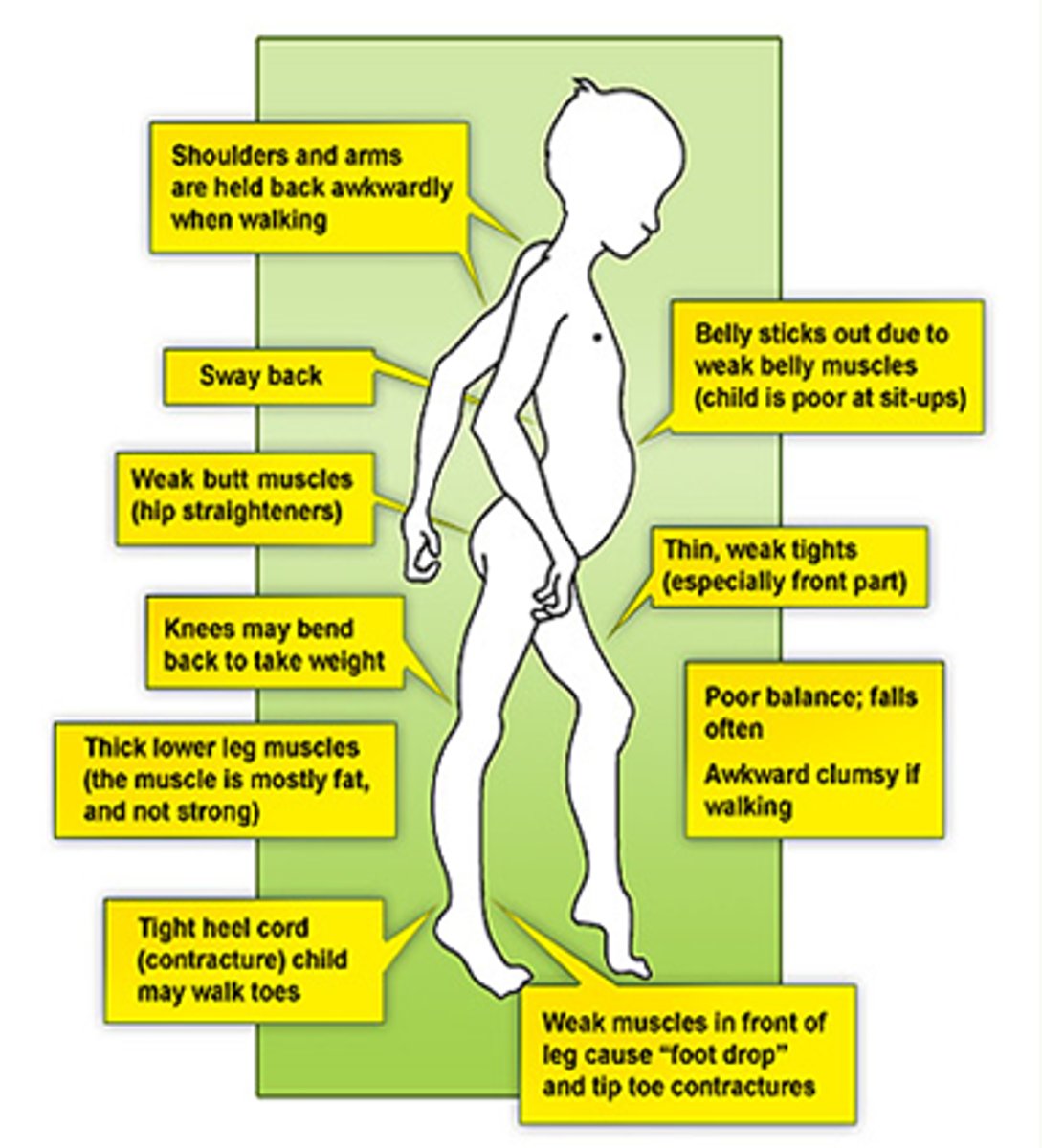 <p>Waddling gait, frequent falls, Gower's sign, lordosis, enlarged muscles, profound atrophy in later stages, cognitive impairment, complications</p>