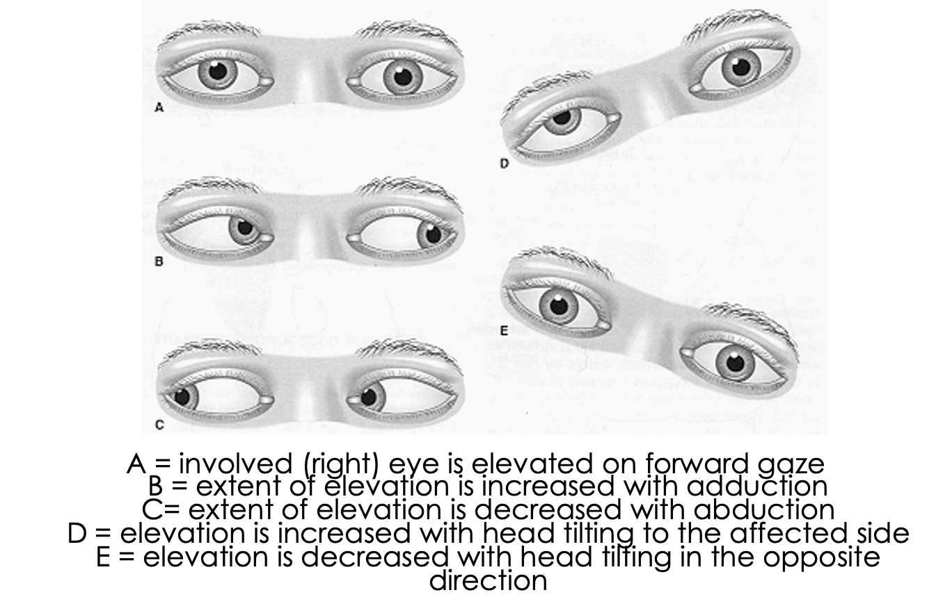 <p>What condition?</p><ul><li><p>(vertical) diplopia</p></li><li><p>eye deviates upward and slightly medially</p></li><li><p>MCC- blunt head trauma (other- microvascular infarct d/t DM, neoplasms, inflammation, infx)</p></li></ul><p></p>