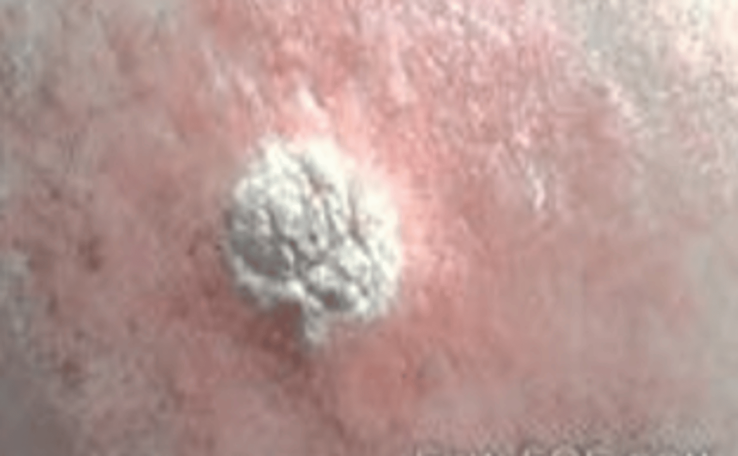 <p>barnacles of old age, benign raised yellowish lesions that feel greasy and velvety, or warty, often found on head, back, or neck</p>