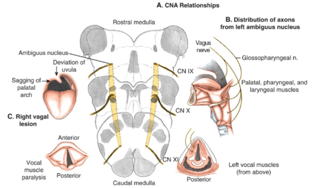 <p><span style="color: rgb(17, 5, 5);">NUCLEUS AMBIGUUS - CNs IX, X, AND XI</span></p>