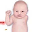<p>What pathology is seen in this image?</p>