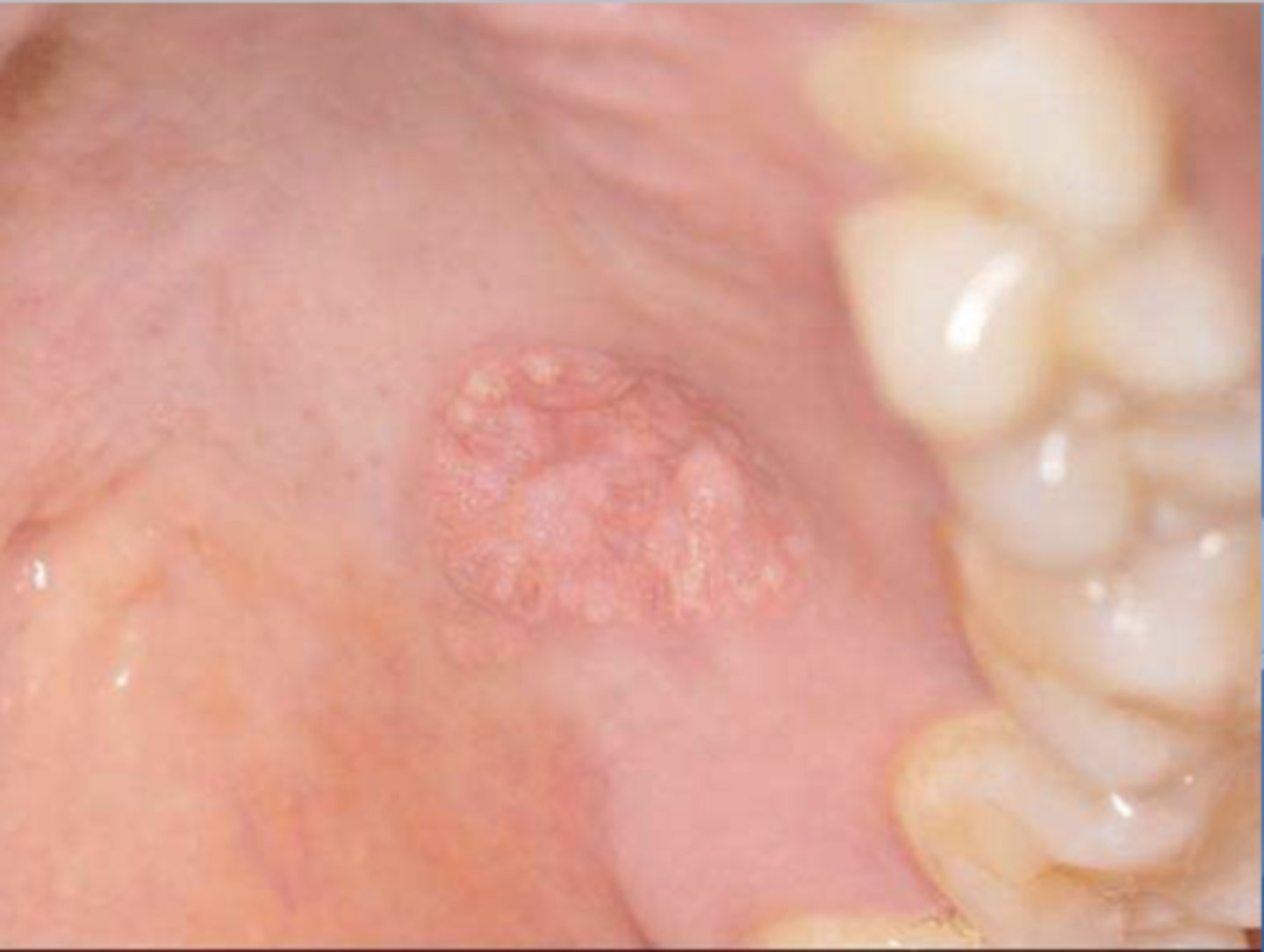 <p>the following are the clinical features of what?</p><p>-50% of oral lesions on the gingiva or alveolar mucosa</p><p>-may be pink, white, red, yellow, or orange</p><p>-well-demarcated verrucous mass</p><p>-may resemble squamous papillomas or early carcinomas</p>