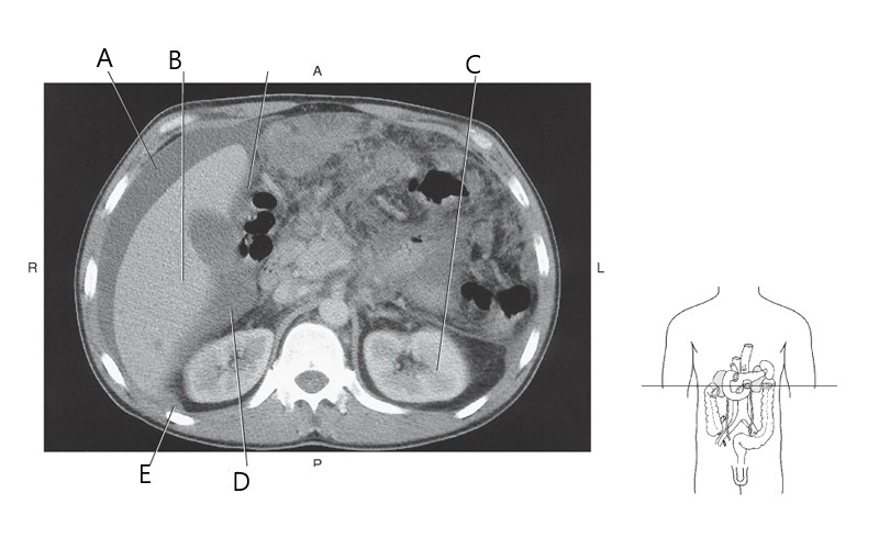 <p>Right sub hepatic</p>