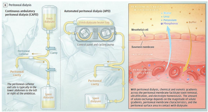 <p>instillation of dialysate into the peritoneal cavity through the PD catheter</p><p>peritoneal membrane = semipermeable membrane between dialysate and blood → abdominal viscera is highly vascularized </p><p>solutes are removed from blood across peritoneal membrane by diffusion and convection (solute drag)</p><p>excess plasma water removed by ultrafiltration </p>