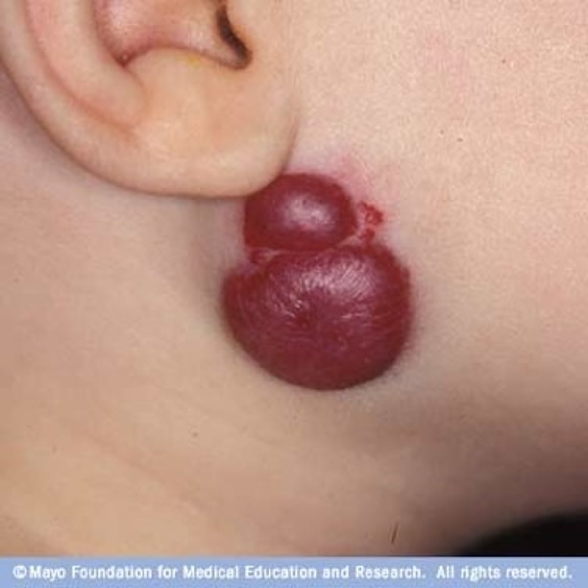 <p>-Form of a birthmark</p><p>-Bright red patch or nodule of extra blood vessels in the skin</p><p>-Grows during first year of life (recedes over time)</p><p>-Benign, not associated with other medical conditions</p>