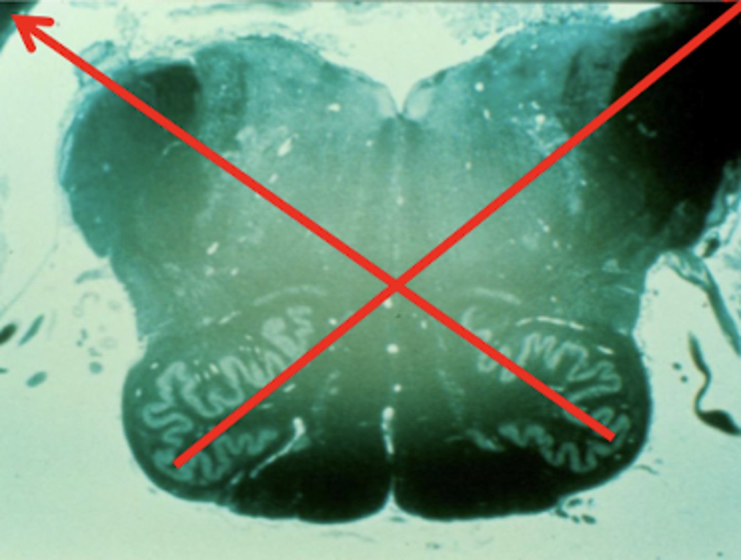 <p>contralateral -- eventually will reach the (contralateral) cerebellar hemisphere</p>