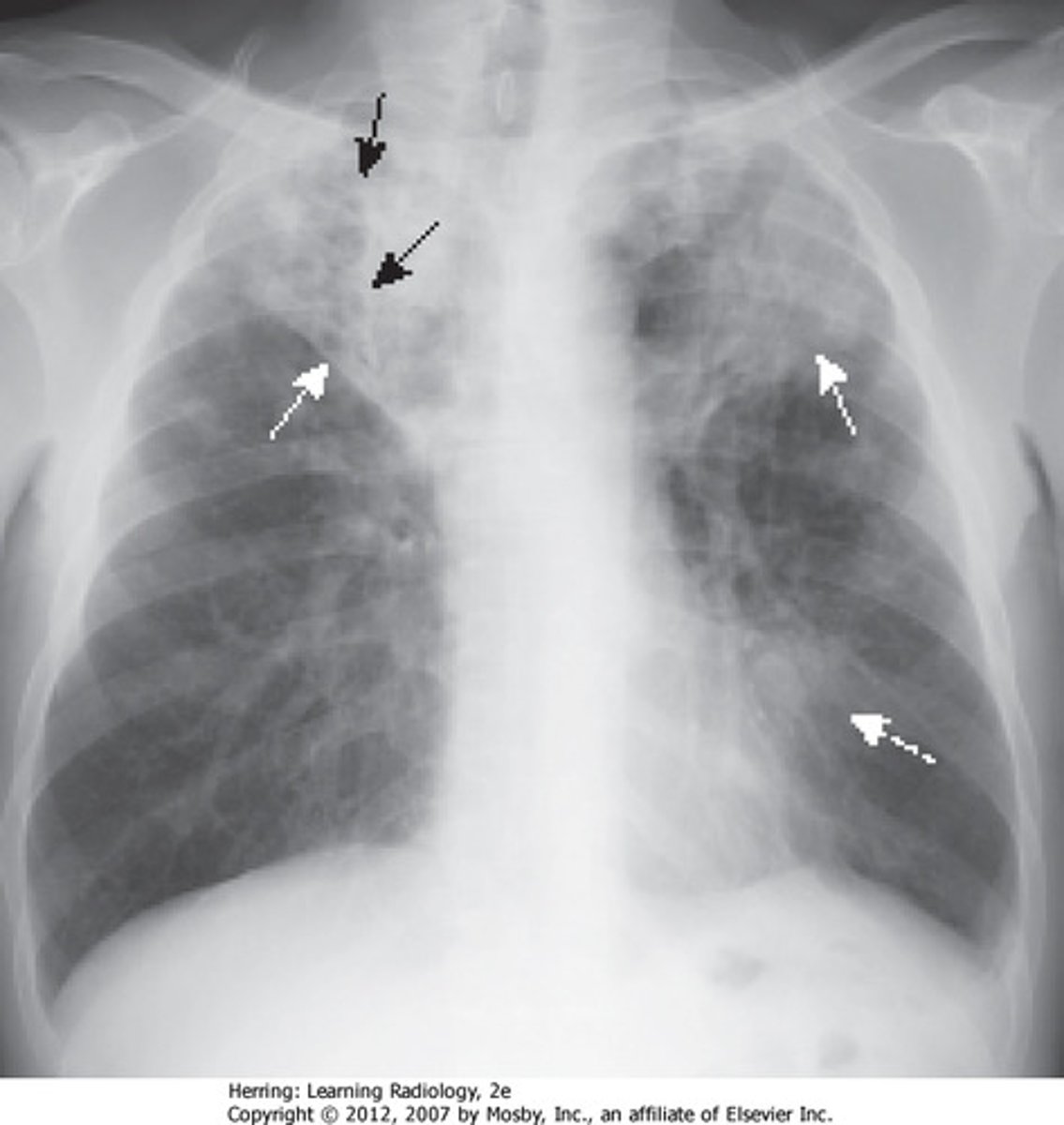 <p>bacterial infection of the lungs</p>