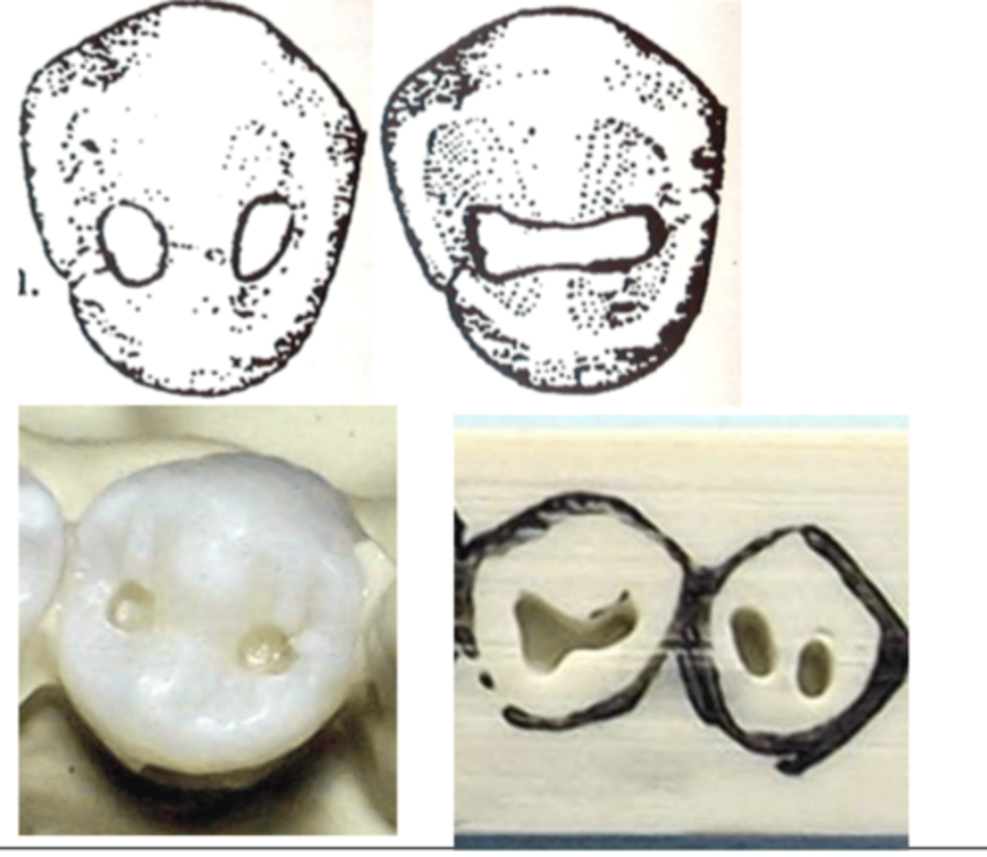 <p>cross the transverse ridge from mesial to distal pits and create one large occlusal preparation</p>