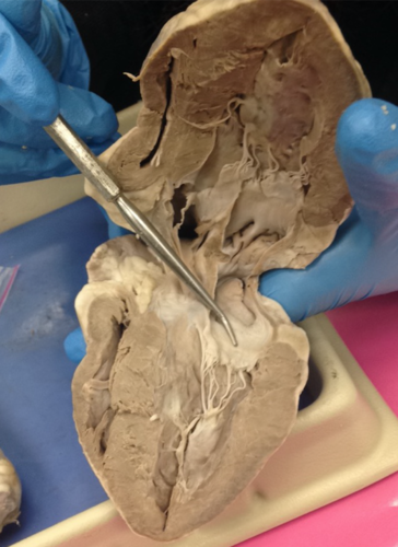 <p>type of valve</p>