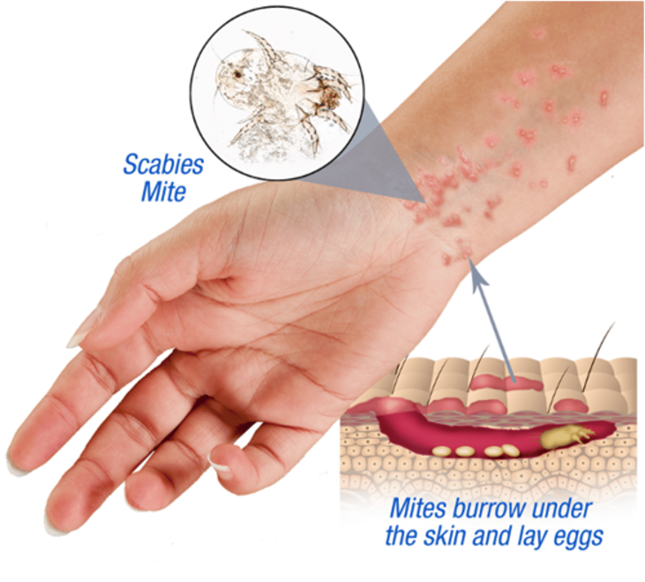 <p>burrows into skin, and causes itching</p>