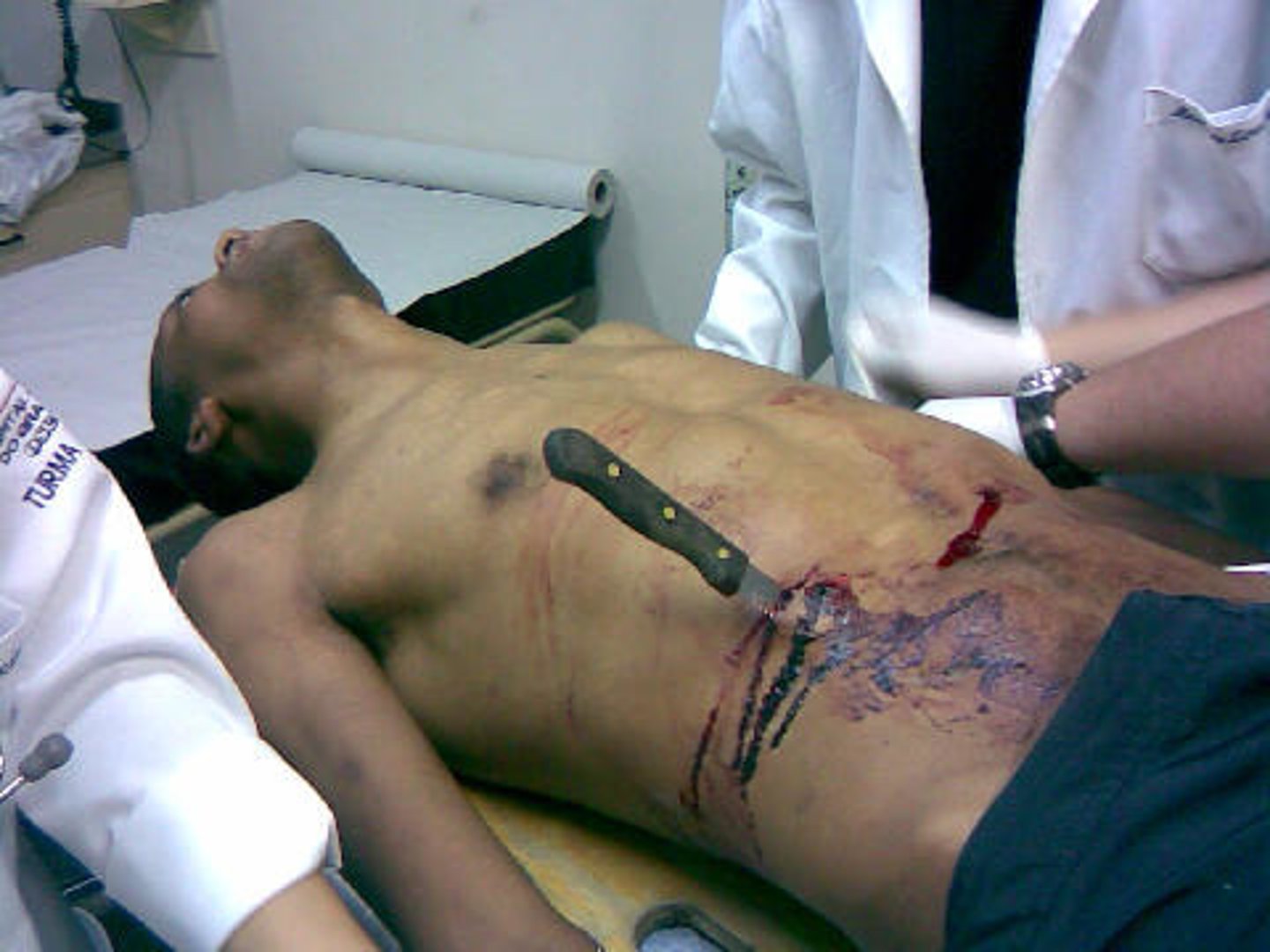 <p>Like a puncture wound, but the item remains embedded in the tissue.</p>